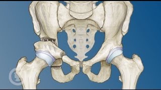 Hip Preservation Options for Young Adults