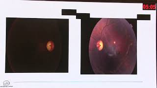 AIOC 2026   IC263   T Dr Manjushree Bhate Hereditary Optic Neuropathy an Update
