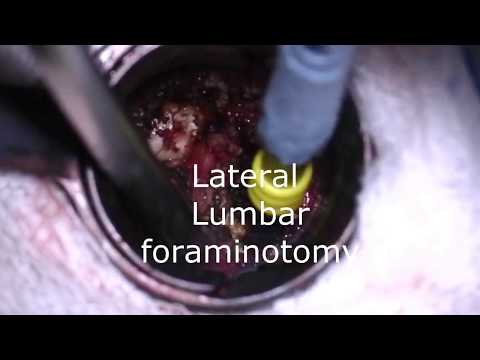 Minimal invasive Lumbar foraminotomy توسيع الثقبة الفقرية القطنيه