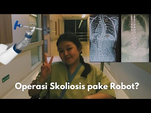 Operasi Skoliosis pake Robot di Eka Hospital