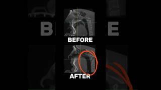 Sleep apnea just got a whole lot easier!