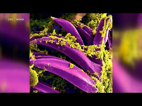 Suspected pneumonic plague cases in Russia spark international concern