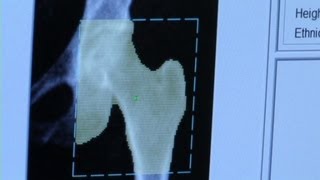 A test to red flag osteoporosis