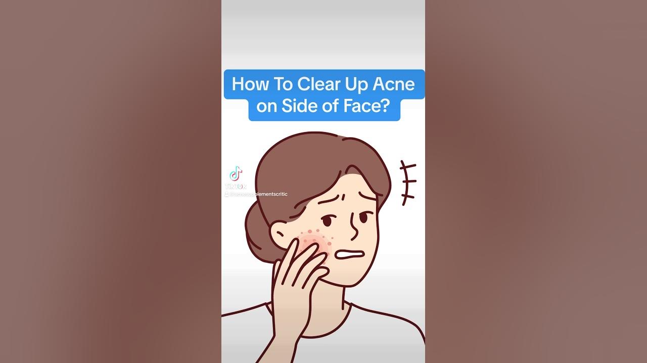 Severe Acne On One Side Of Face