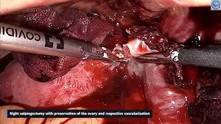 Ruptured Ectopic Pregnancy_ A Life-Threatening Hemoperitoneum Managed Laparoscopically - final