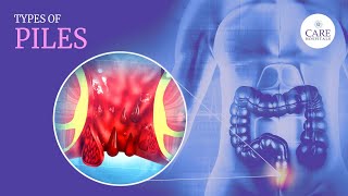 What are Hemorrhoids(Piles) | What are the Types of Piles | How to Diagnose Piles?| बवासीर
