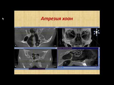 Зубарева А.А. «Диагностика полости носа и околоносовых пазух по данным КЛКТ»