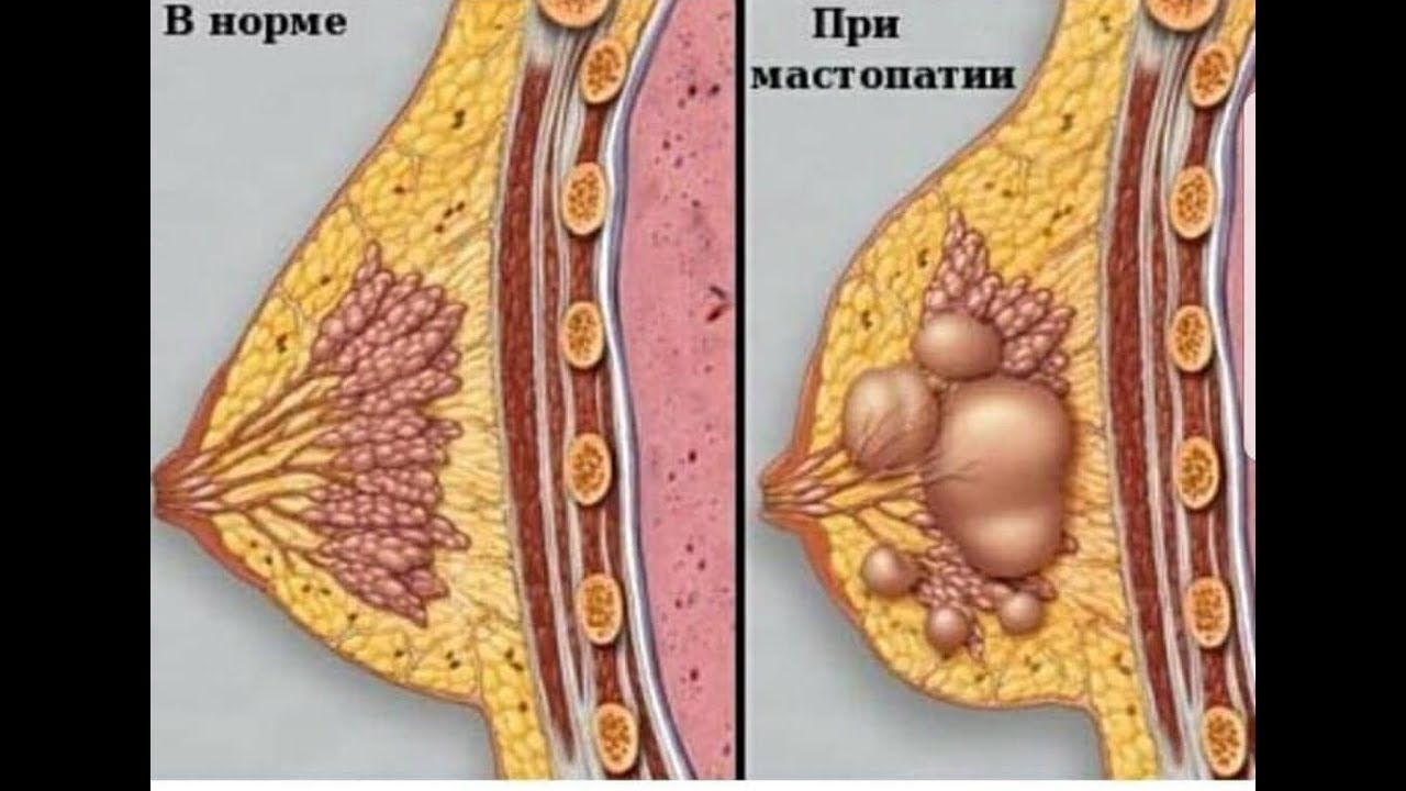 Быстрое лечение лактостаза, мастита при грудном вскармливании - YouTube