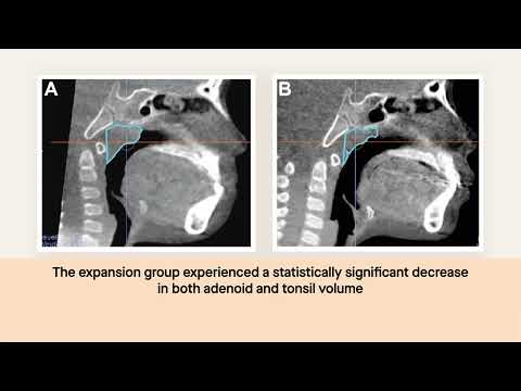 Palate widening with orthodontics reduces the size of adenoids and tonsils in children