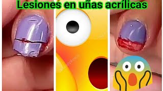 Lesiones en uñas acrílicas. Primeros Auxilios en uñas acrílicas screenshot 5