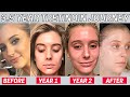 I Used Tretinoin for 3.5 Years and THIS happened... | Tretinoin Update & My Agency Results & Rx