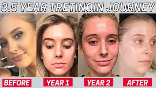I Used Tretinoin for 3.5 Years and THIS happened... | Tretinoin Update & My Agency Results & Rx