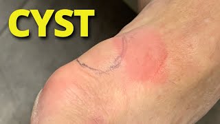 SUCKING OUT A LARGE CYST