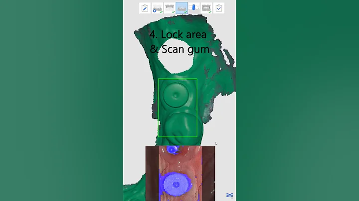 Implant Scan with Scanbody #shorts
