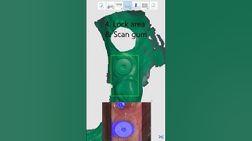 Implant Scan with Scanbody #shorts