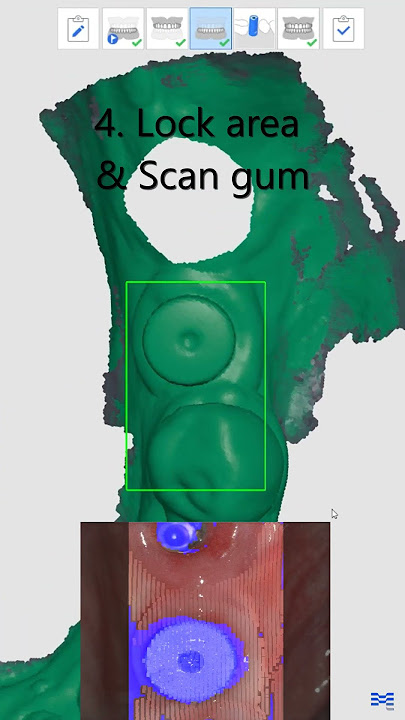 Implant Scan with Scanbody #shorts