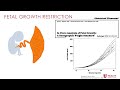 Sex Disparities Imposed by Current Fetal Growth Standards