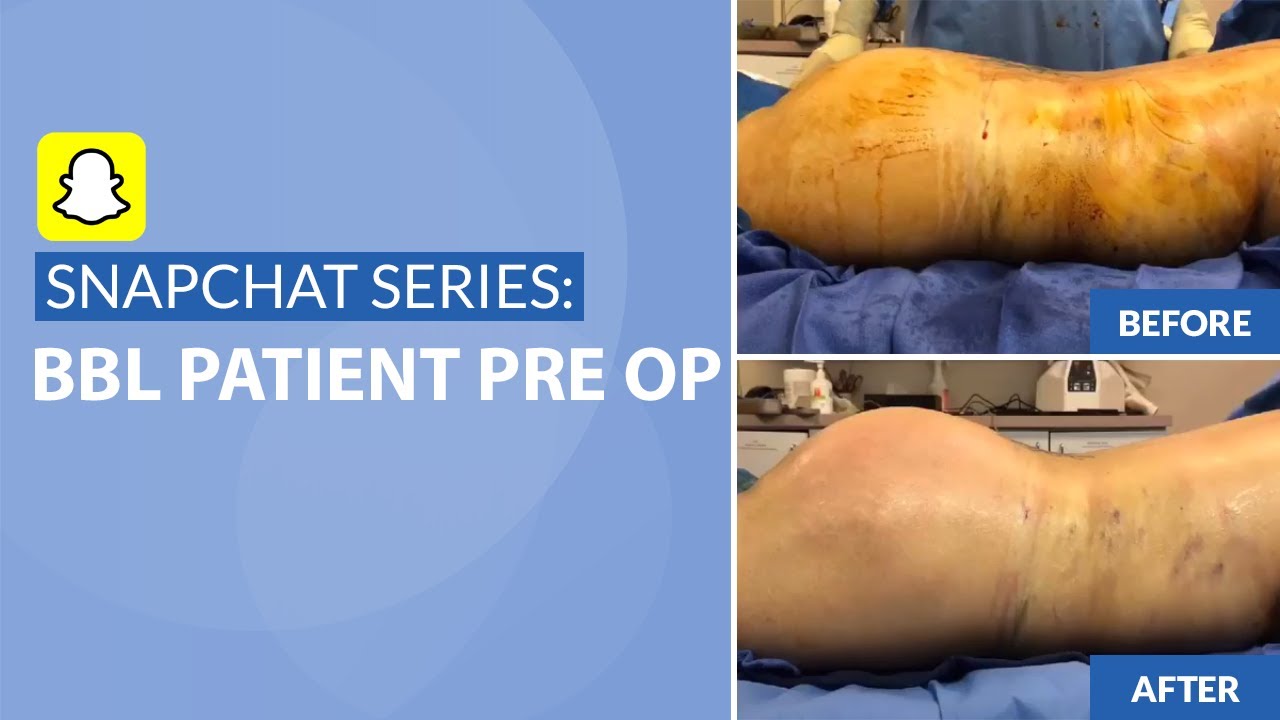 Snapchat Series: BBL Patient Pre Op + Before & After