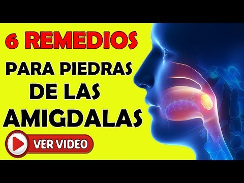 Vídeo: Remedio Casero De Las Piedras De Amígdalas: 10 Tratamientos Para Probarse