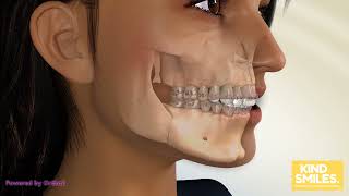 Famous BSSO Mandibular Setback Bracket with Face Profile