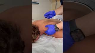 דיקור יבש לשריר הטרפז