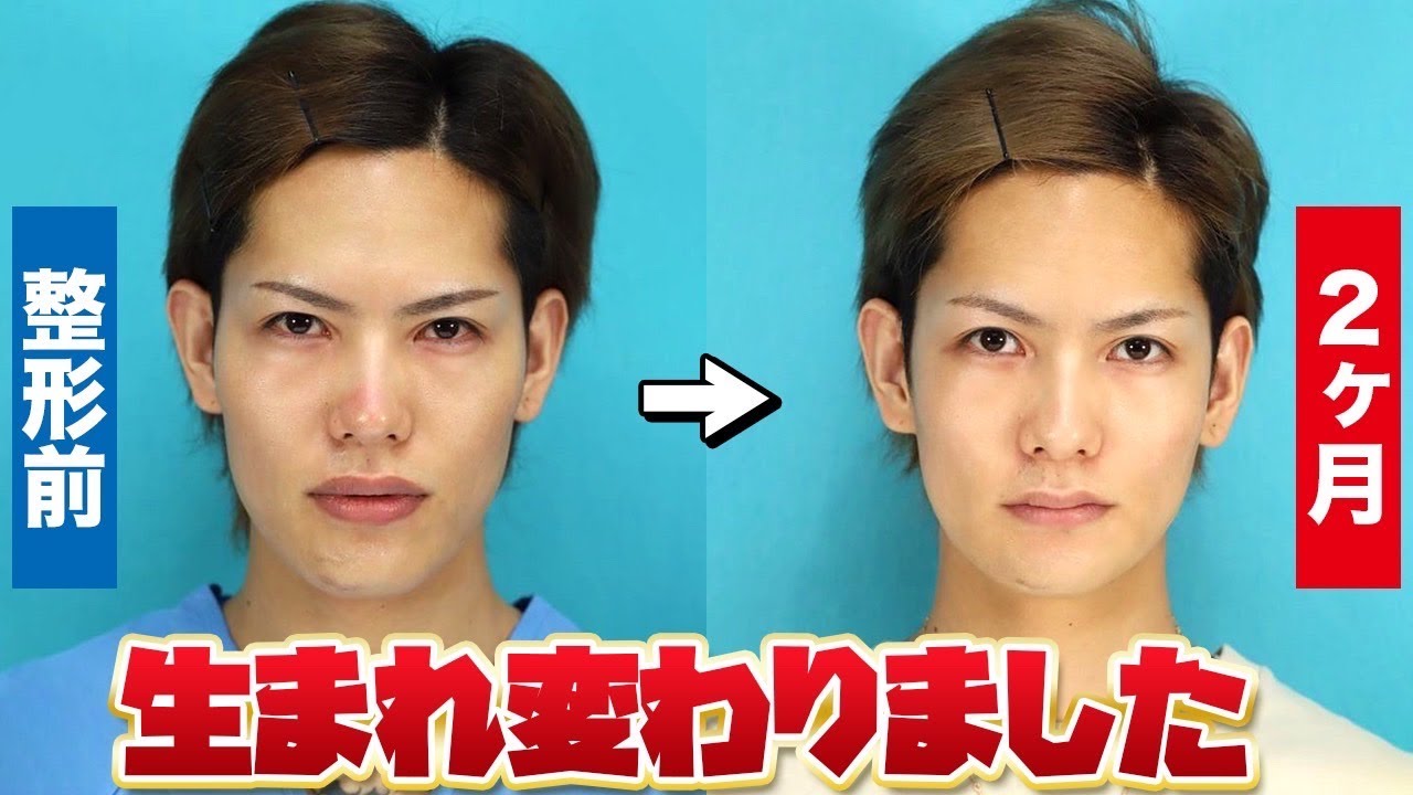 【両顎骨切り手術-ルフォー】手術後2ヶ月でここまで変化が...術後2ヶ月に密着 - YouTube