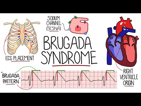 Brugada Syndrome Explained  (Includes ECG) - "Sudden Unexplained Nocturnal  Death Syndrome"