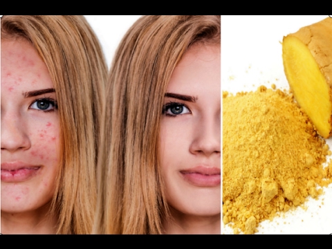 How to Get Rid Of Acne With Ginger