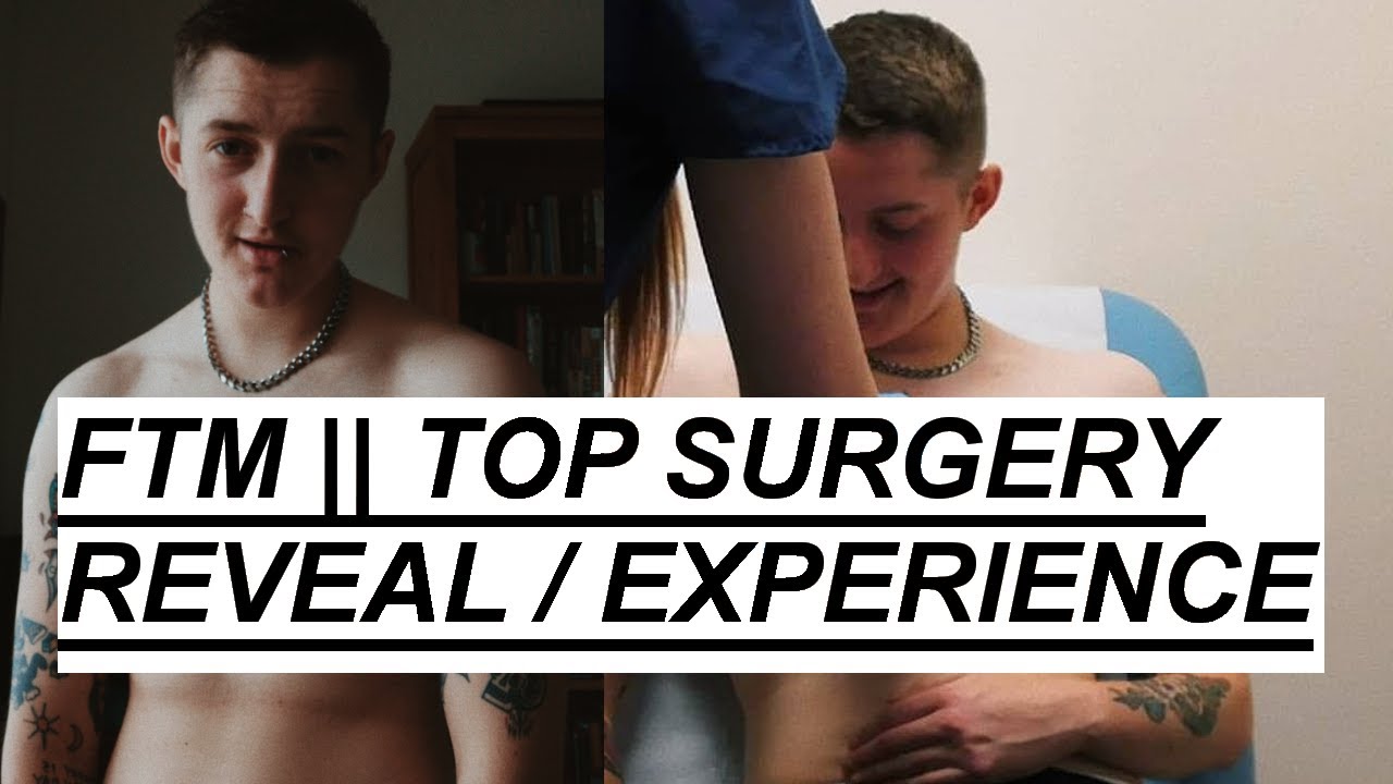 FTM TOP SURGERY || Experience/Reveal (Miles Berry, Double Incision ...