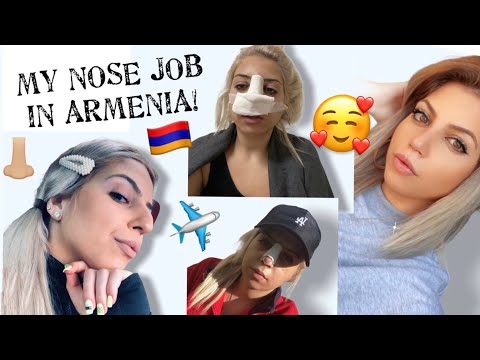 Video: Anastasia tom qab rhinoplasty thiab mammoplasty