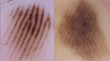 Dermoscopy of acral and nail lesions (basic)