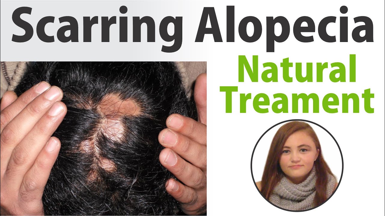 The Best Scarring Alopecia Natural Treatment in USA at Alopecia