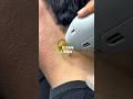 ND YAG Laser Hair Removal For The Dark Hair
