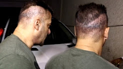 Salman Khan Hair Transplant Goes Wrong