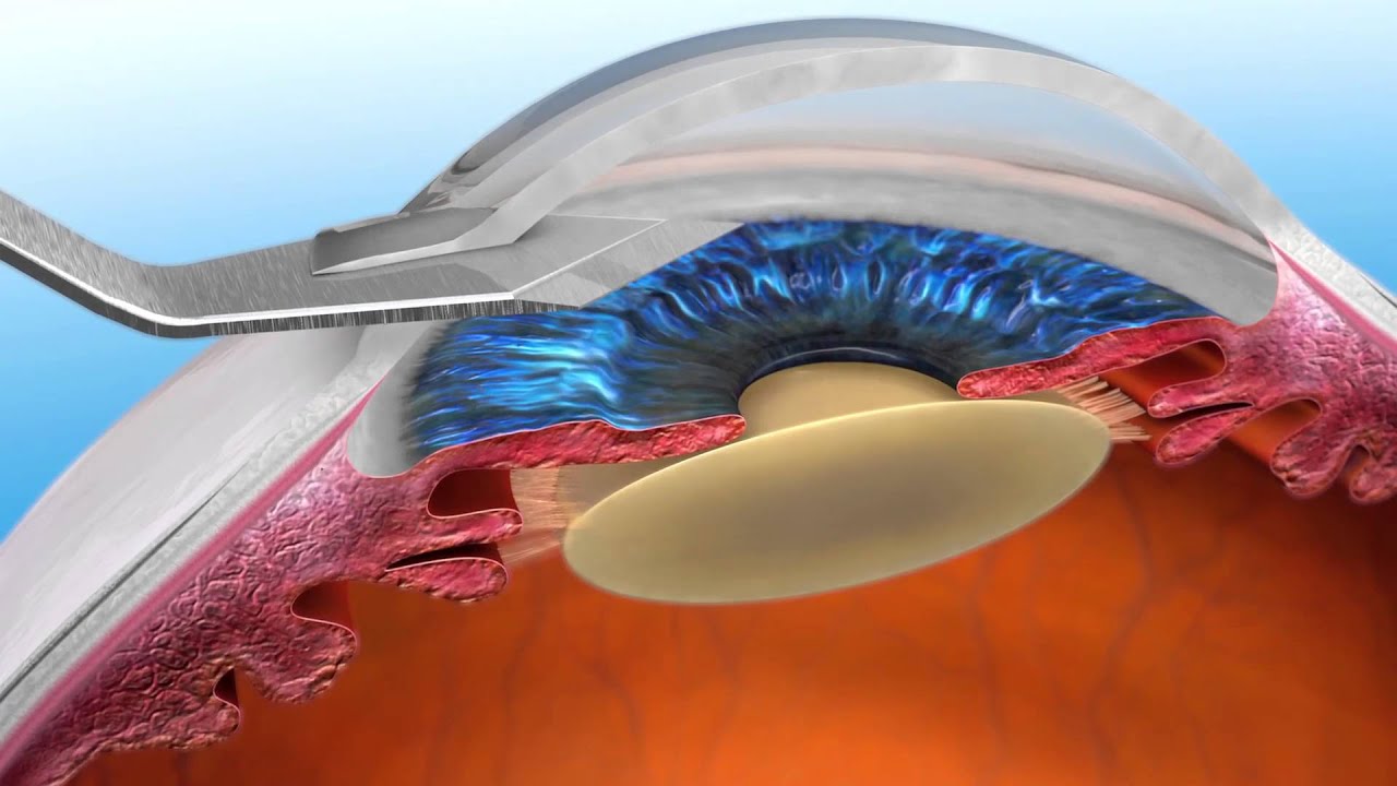 Глазные клиники замена хрусталика. Капсулярная врожденная катаракта. Факоэмульсификация катаракты. Искусственный хрусталик.