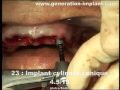 Implants dentaires  mci bimaxillaire flapless