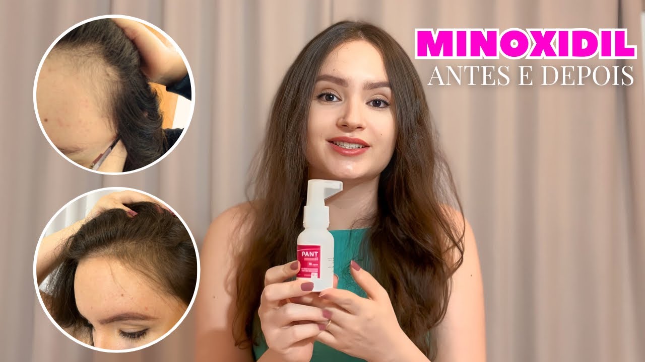 MINOXIDIL - minha experiência completa ao longo de 1 ano de uso - YouTube