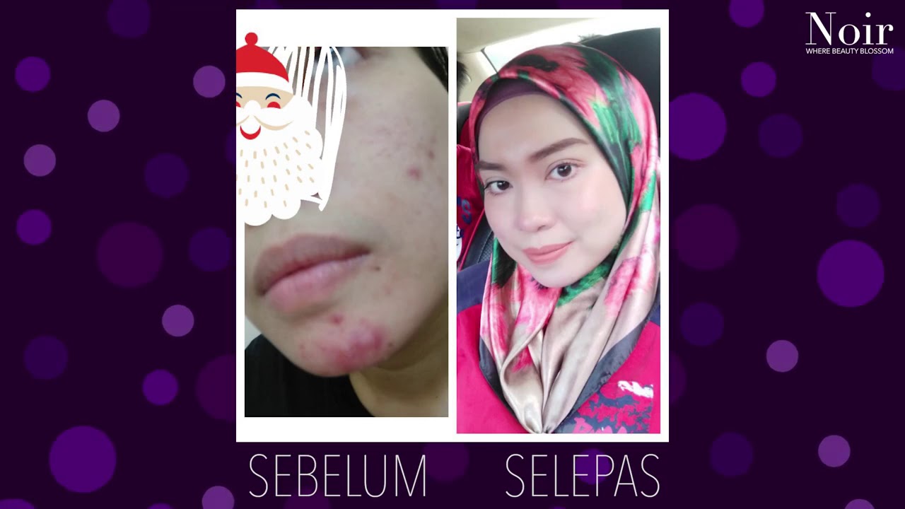 noir skincare testimoni
