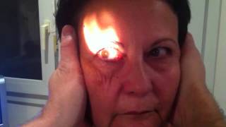 Head Impulse Test and Left Positive Saccade by Vestibular Neuritis