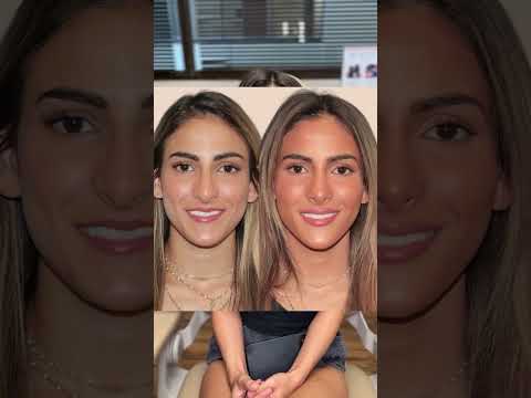 Video thumbnail: Patient Testimonial - Rhinoplasty with Dr. Rousso | Rousso Adams · Rousso Adams Facial Plastic Surgery