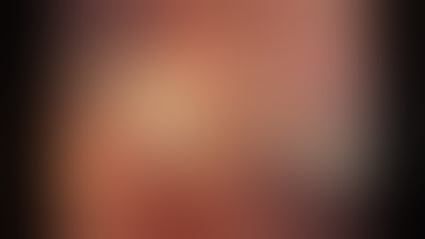 Laparoscopic simple nephrectomy