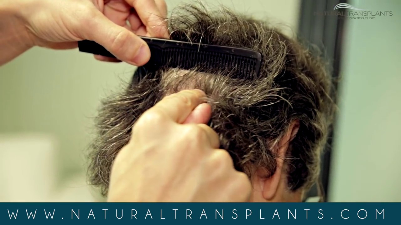 Best Hair Doctor Near Miami, FL Hair Doctor Miami, FL YouTube