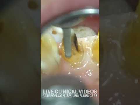 Video: Dajú sa zanedbané zuby zachrániť?