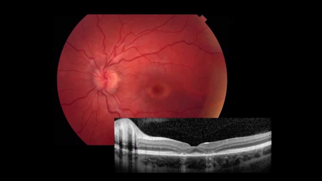 Retina Imaging & ERG YouTube