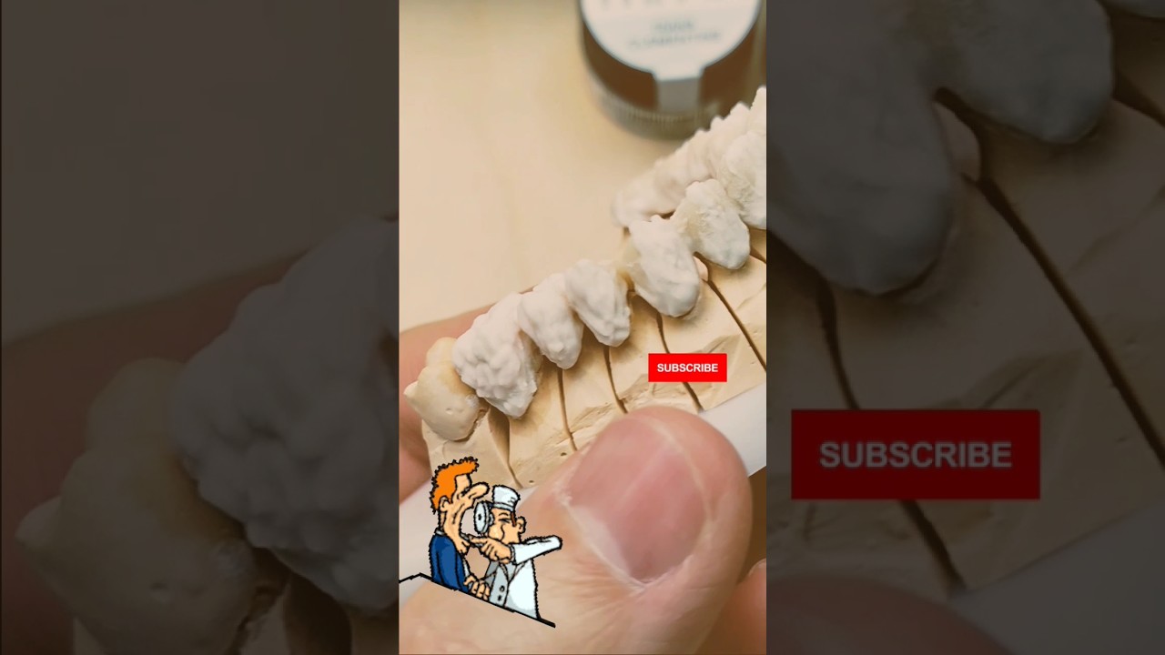 Zirconium bridge before firing 