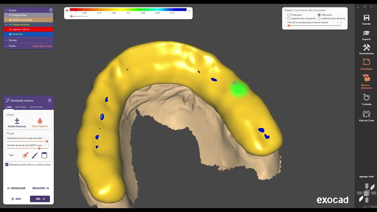 Exocad Galway - Diseño  férulas de descarga