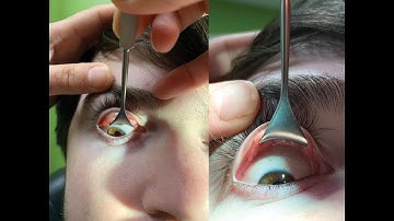 CPT code for Removal of Foreign body - simplify medical coding