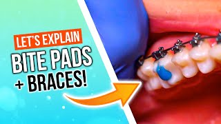 What Are Bite Pads For Braces?