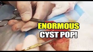 Enormous Cyst Removal!  Dr. Gilmore's Biggest Cysts!