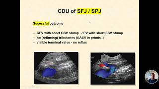ColourDuplex Ultrasound in Recurrent Varicose Veins-El examen EcocolorDoppler en Varices Recidivadas